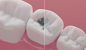 Illustration contrasting amalgam filling with tooth-colored filling