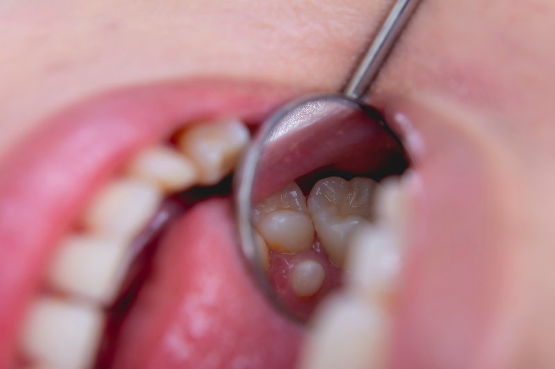 A closeup of a mouth with shark teeth